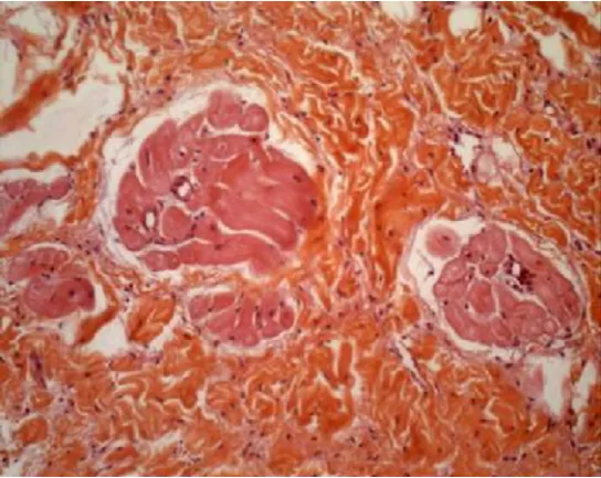 Figure 1 : étude histologique de l’oreillette gauche après radiofréquence bipolaire