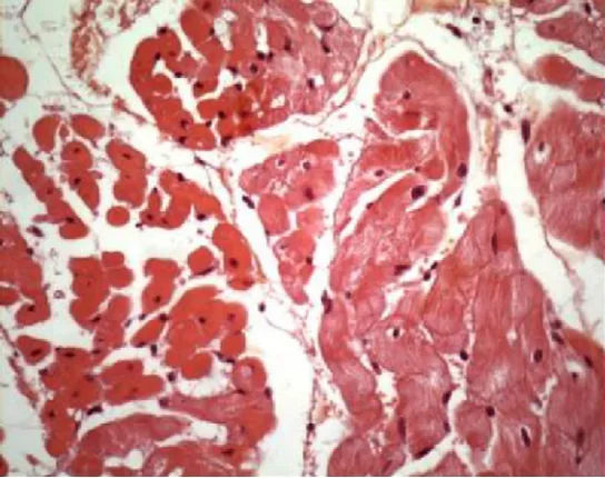 Figure 3 : nécrose et raréfaction myocytaire après cryoablation
