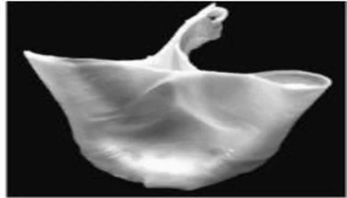 Néo-valve aortique en péricarde autologue