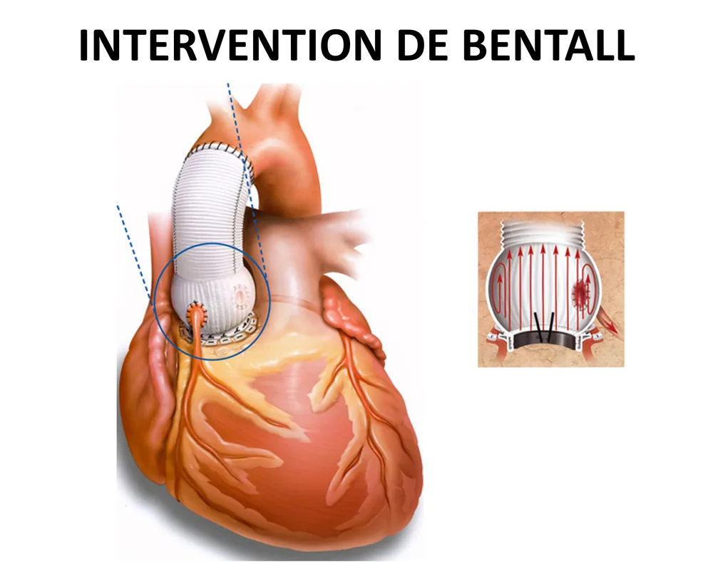 Schéma de l’intervention de Bentall : tube en Dacron et valve artificielle