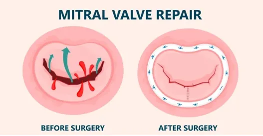 Plastie mitrale : la valve avant et après la réparation chirurgicale
