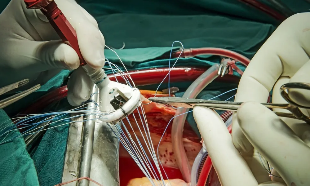 Remplacement d’une valve par une prothèse mécanique pendant une chirurgie à cœur ouvert
