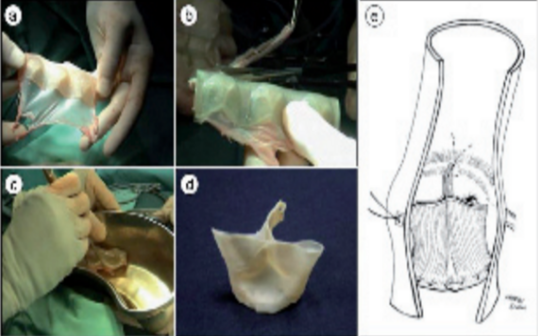 De nouveaux matériaux pour les valves cardiaques